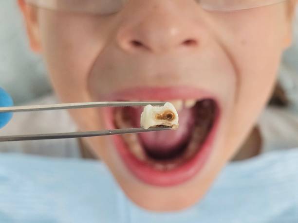 Best Chipped Tooth Repair Near Me  in Ashtabula, OH